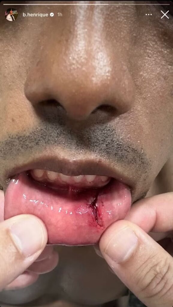 Bruno Henrique posta foto de boca cortada após partida contra o Atlético-GO